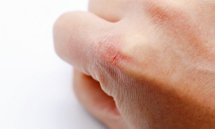 手荒れのサインを見逃さないで！