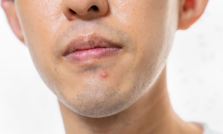 皮脂による肌トラブルとは？