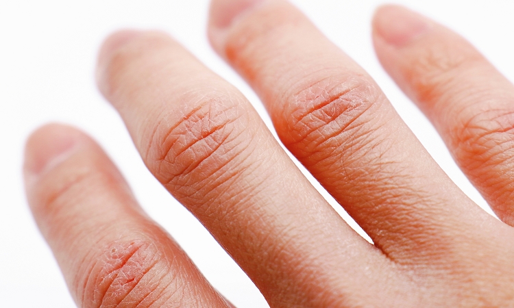 手荒れが起こる3つの原因